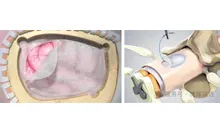 ​Good News: Biosis Healing Dural Repair Patch Approved as Class D Medical Device in Vietnam